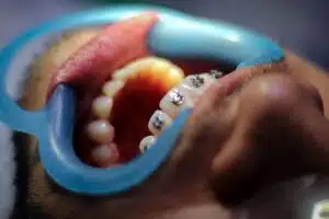 The Stages of Braces The Stages of Braces