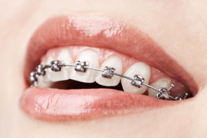 Braces Port Chester, NY