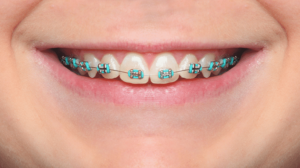 foods you can eat with braces