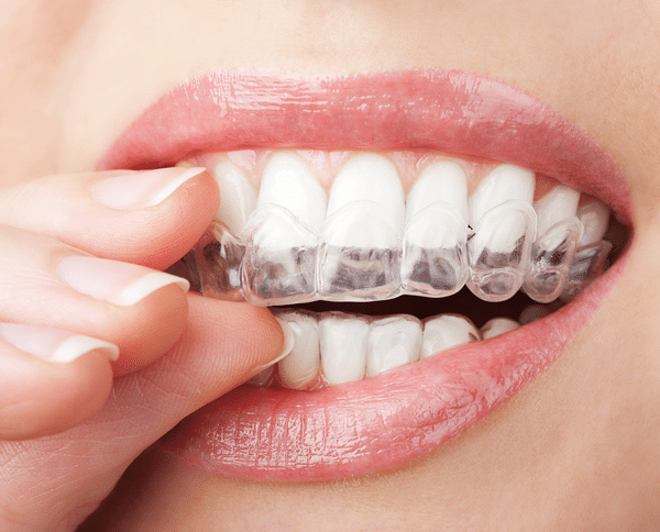 average cost of invisalign riverside ct