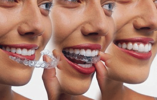 how to make invisalign aligners more comfortable riverside