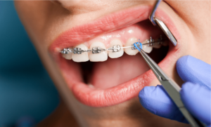 signs of tooth decay with braces