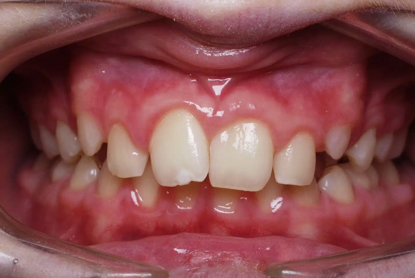 AD 2 pretx AD 2 pretx