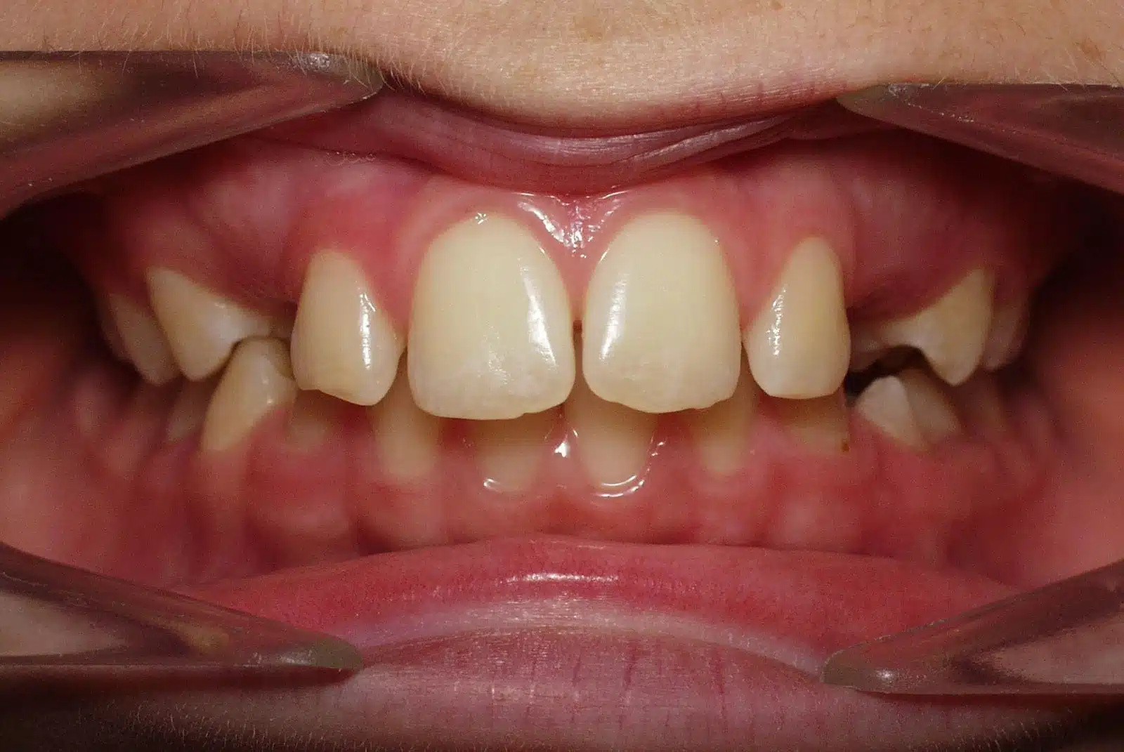 CD 2 pretx CD 2 pretx