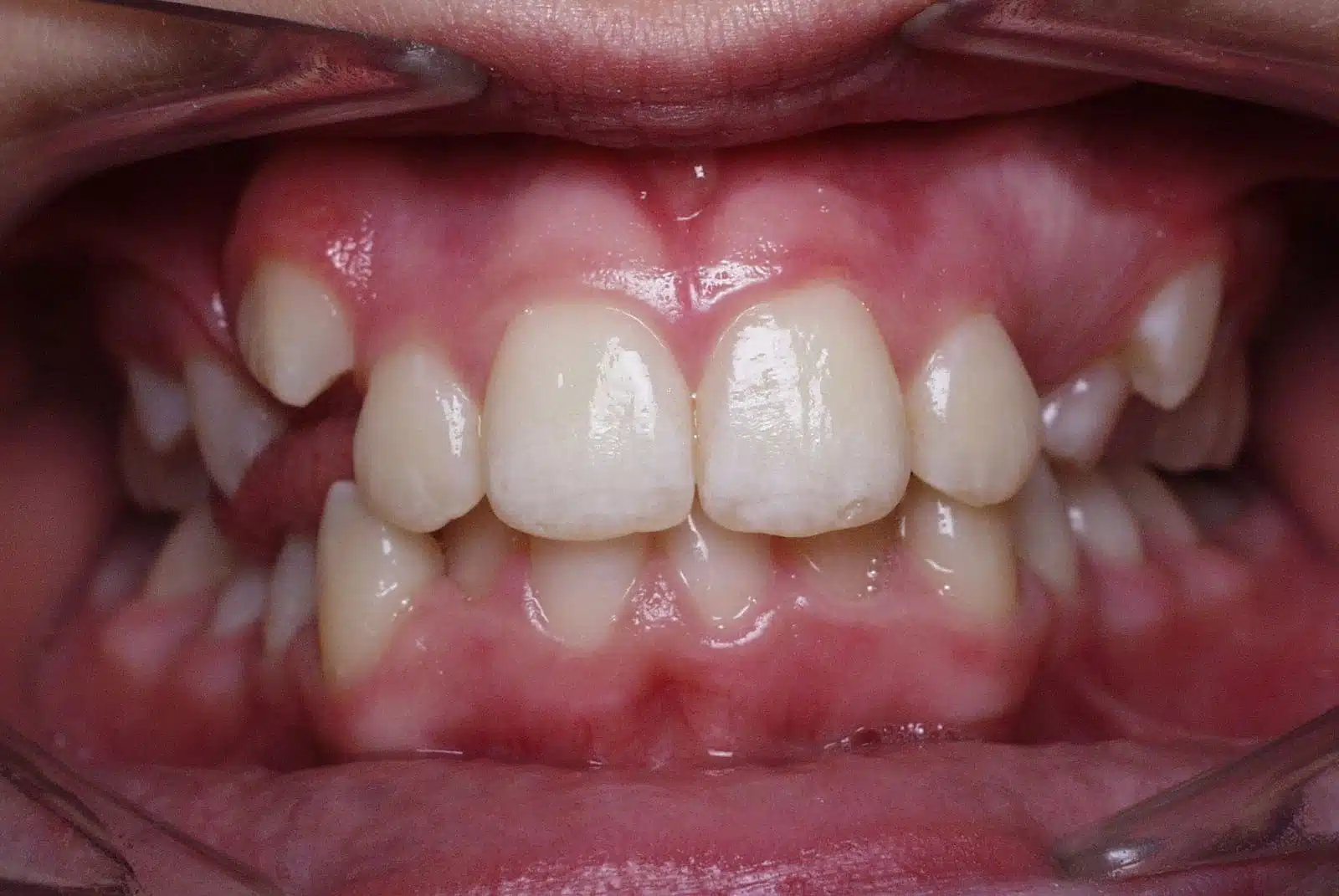 EL 2 pretx EL 2 pretx