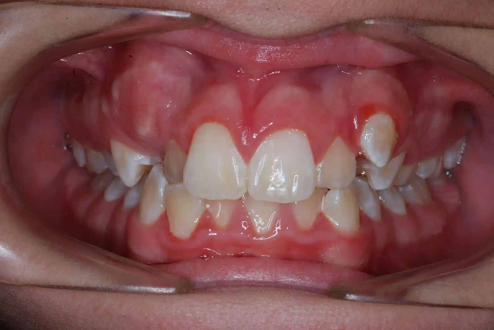 SA 2 pretx SA 2 pretx