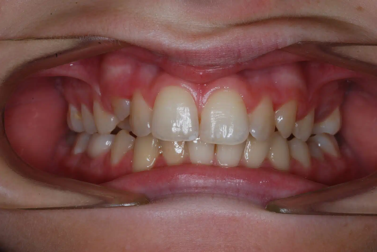 SE 2 pretx SE 2 pretx