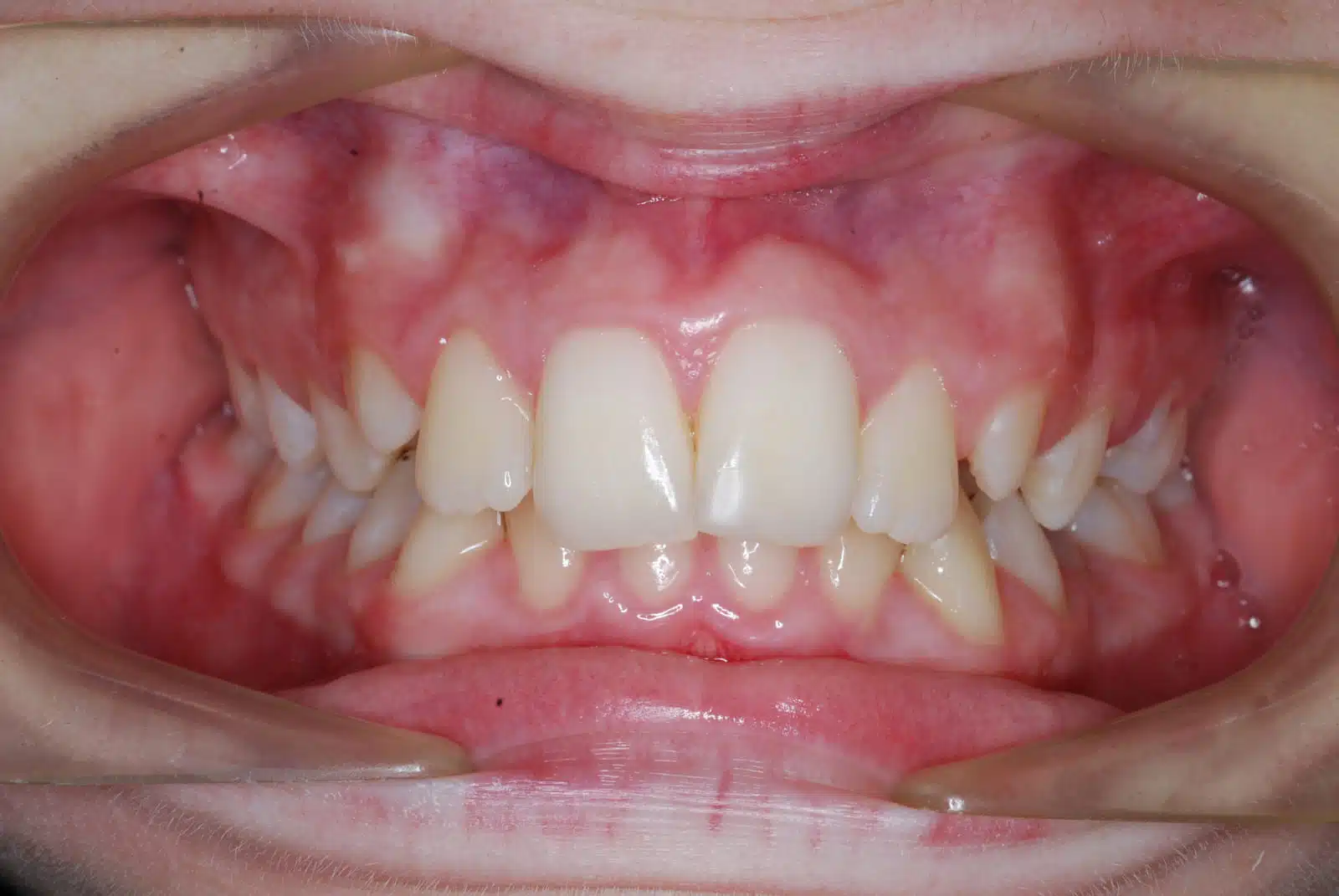 SL 2 pretx SL 2 pretx