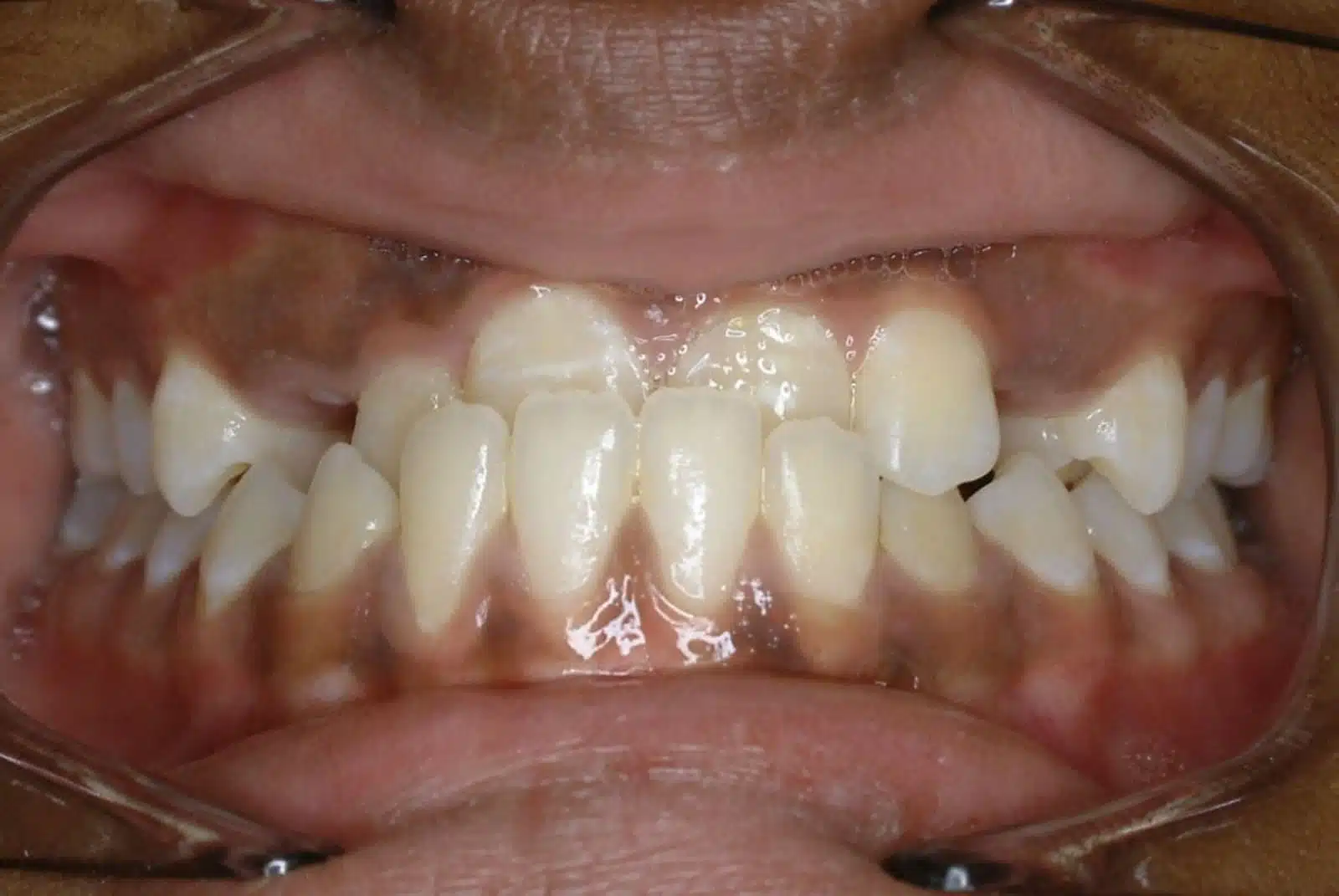 SS 2 pretx SS 2 pretx