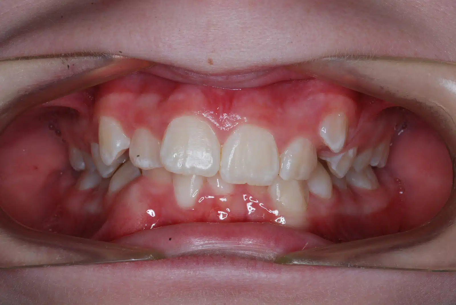 TH 2 pretx TH 2 pretx