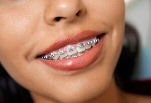 Patient smiling with metal braces used to correct crowded teeth